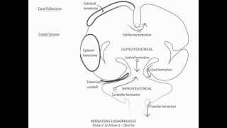 Herniation amp Intracranial Hemorrhage  Draw it to Know it Neuroanatomy [upl. by Westney849]