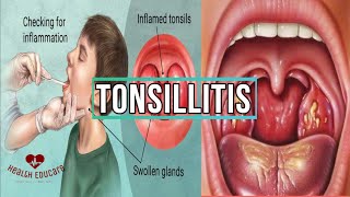 All you need to know about Tonsillitis [upl. by Alius]