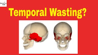 Cancer Wasting  Temporal Wasting  Wasting Syndrome  Malignant Cachexia [upl. by Jedlicka917]