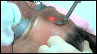 Sciton  ProFractional Therapy [upl. by Notxarb]