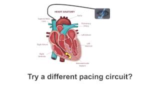 Pacemaker Issues Explained Part 4 Expert Troubleshooting Tips [upl. by Eelynnhoj713]