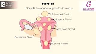 What does big uterus mean  DrSmitha Sha of Cloudnine Hospitals  Doctors Circle [upl. by Oicneconi]