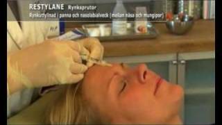 Restylane och Botox behandling [upl. by Searcy]