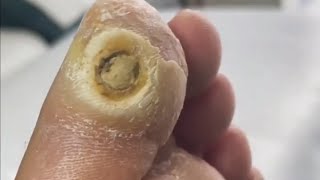 Pedicure video34，vertical plantaris，plantar wart [upl. by Yttel738]