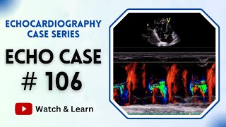 ECHO Case 106  Echocardiography for Beginners echocardiogram [upl. by Aceissej]