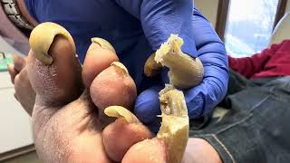 Unbelievable Toenails so long and painful that patient cannot walk [upl. by Kalvn]