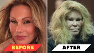 Celebrities botched plastic surgery Before And After❗😱 [upl. by Gnof]