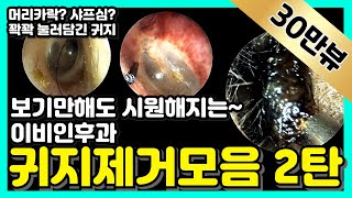 보기만해도 시원해지는 이비인후과 귀지제거모음 2탄 Earwax removal [upl. by Markman477]