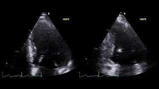 2D Echocardiographic Morphology of EndDiastolic and EndSystolic Volume [upl. by Ssitnerp13]