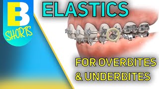 Braces Elastics for Overbite and Underbite shorts [upl. by Hale]