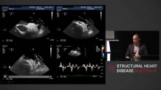 Detection of Left Atrial Thrombus  AProf Phillip Mottram [upl. by Aleakam]