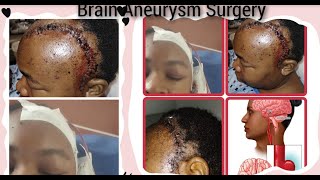 Brain Aneurysm Surgery [upl. by Orelu]