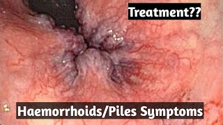 HaemorrhoidsPiles treatment what are its symptoms [upl. by Alodi]