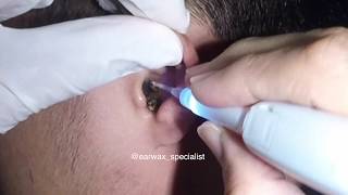 Mans MASSIVE Earwax Softened and Removed with Hydrogen Peroxide [upl. by Astraea]