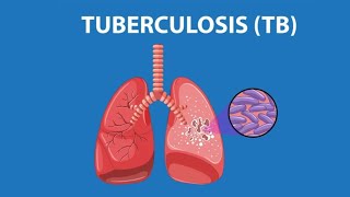 Tuberculosis TB Causassíntomasdiagnóstico tratamiento patología Infección tuberculosa [upl. by Remliw]