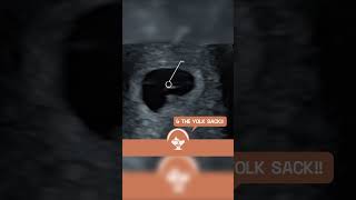 Yolk Sack and Heartbeat at 6 weeks Pregnancy EarlyDetection ViabilityScan [upl. by Mharg793]