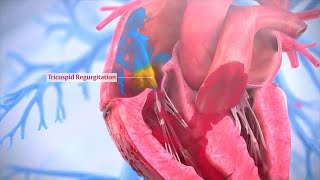 Tricuspid Valve Repair  Triluminate Clinical Trial [upl. by Anairda]