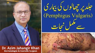 What is Pemphigus Vulgaris  Skin disease  Happy Patient  Prof Dr Azim  Cosmetique [upl. by Cosimo693]