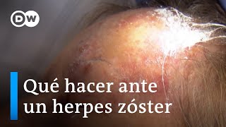 Primero varicela luego herpes zóster [upl. by Cohberg]