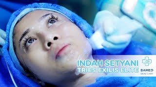 Indah Setyani Tries Exilis Elite  Bamed Skin Care [upl. by Esirahc791]