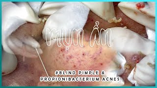 Big Cystic Acne Blackheads Extraction Blackheads amp Milia Whiteheads Removal Pimple Popping [upl. by Ocana924]