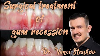 Surgical technique for treating gum recession Dr Venci Stankov [upl. by Ysied68]