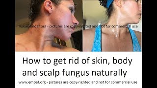 How To Kill Severe Ringworm on Skin Body amp Scalp for adults and kids [upl. by Apfel]