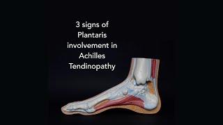 3 signs of Plantaris involvement in Achilles Tendinopathy with Tom Goom [upl. by Aihsotal]