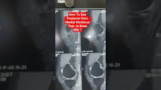 How To See Posterior Horn Medial Meniscus Tearin Knee MRI  drsaichandra kneemri [upl. by Avril]