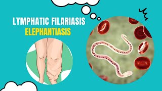 Unlocking the Secrets of Elephantiasis What You Need to Know [upl. by Eizzik]