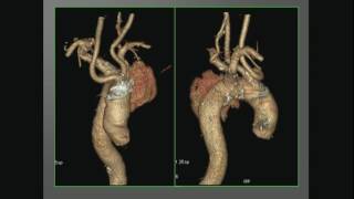 Sesja X  Tętniaki piersiowe piersiowobrzuszne aorty [upl. by Ainav]