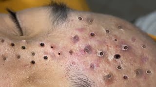 Loan Nguyen Acne Treatment 11 [upl. by Neggem366]