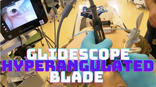 How to Intubate your patient with a GlideScope Hyperangulated Blade [upl. by Cerallua]