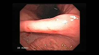 Video clip of an Upper Endoscopy [upl. by Yecaj515]