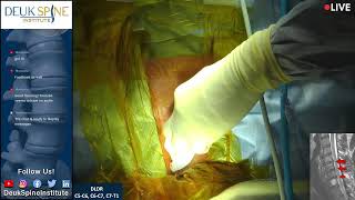 Watch Live Spine Surgery Deuk Laser Disc Repair C5C6 C6C7 C7T1 [upl. by Ayotac900]