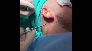 Otoplasty Surgery Under Local Anesthesia [upl. by Wallinga839]