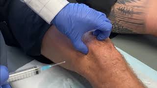 KNEE Intraarticular injection of Local Anaesthetic and Steroid [upl. by Wojcik419]