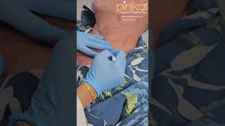 Seborrheic Keratosis Treatment amp Removal using Liquid Nitrogen [upl. by Resarf]