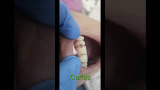 Caries teeth treatment done with finishing and polishingdentist toothdental cosmeticdentistry [upl. by Bena]