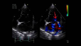 Multiple mitral regurgitation jets [upl. by Kathi474]