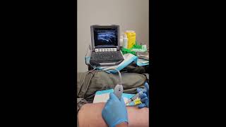 Pes Anserine bursitis injection under ultrasoundguidance [upl. by Neehar]