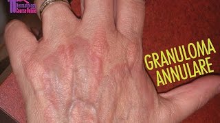 Granuloma Annulare كورس الجلدية الأون لاين [upl. by Arlyn21]