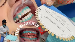 StepbyStep Opalescence Boost Teeth Whitening Procedure  Australia [upl. by Anabahs]