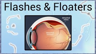 Flashes amp Floaters  A Sign of Retinal Detachment [upl. by Noislla]