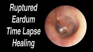 Ruptured Eardrum Healing Closed Time Lapse  A Hole in Eardrum Usually Heals Closed on Its Own [upl. by Assiroc875]