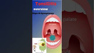 🥵 Tonsillitis Sign And Symptoms🤢youtubeshorts viralvideo shorts trending health reels doctor [upl. by Ulah]