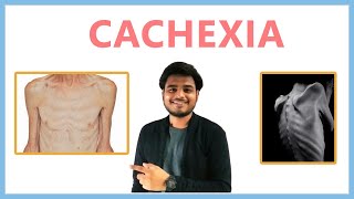 Cachexia wasting syndrome [upl. by Stephens]