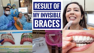 My INVISALIGN Treatment Result🦷 Was This Expensive Process Worth It [upl. by Darach120]