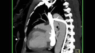 Cardiac Persistent left superior vena cava emptying into coronary sinus 1 of 4 [upl. by Leonor]