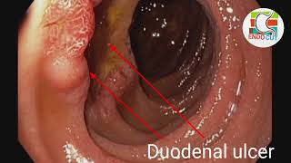 Duodenal ulcer l l endocut [upl. by Nnaacissej]